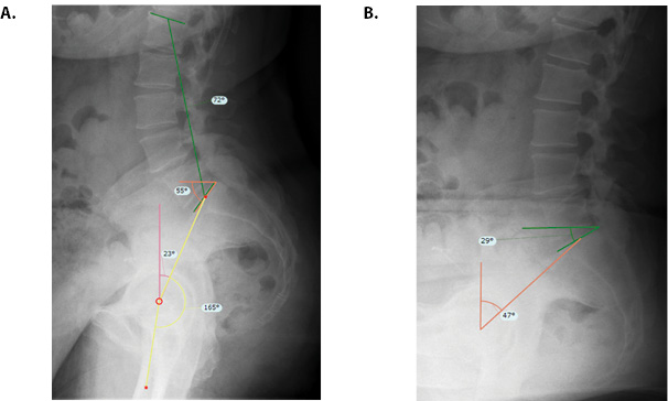 Spinopelvic Mobility THA Figure 2