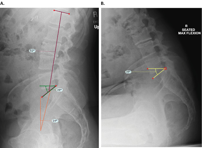 Spinopelvic Mobility THA Figure 4