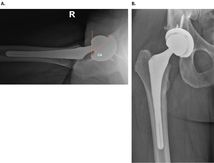 Spinopelvic Mobility THA Figure 5