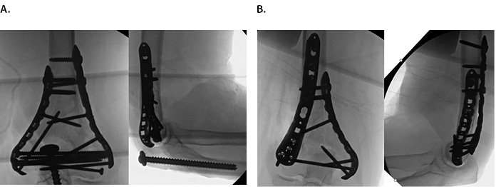 Surgical Fixation Distal Humerus Figure 1