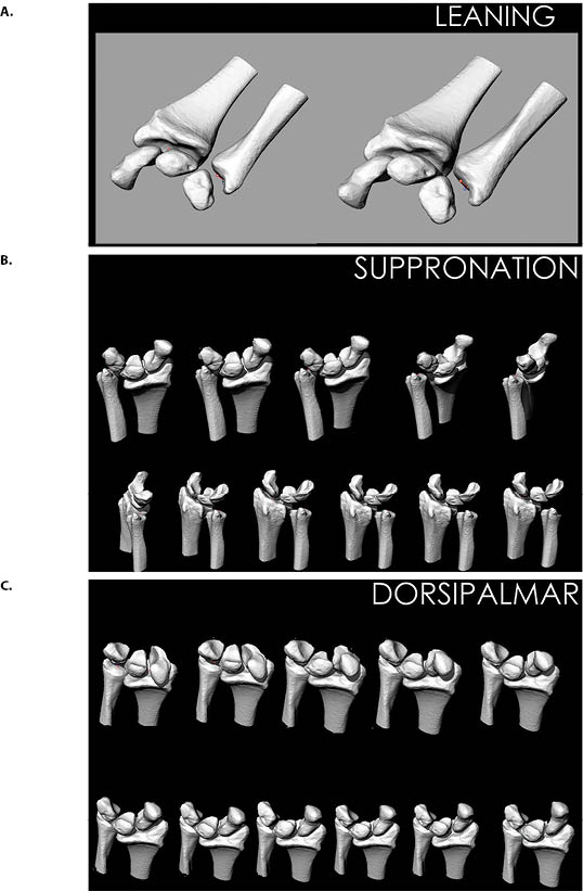 3D CT Wrist Figure 6