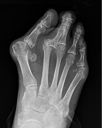 Hallux Valgus Figure 1