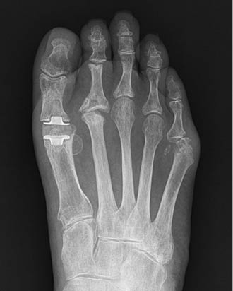 Hallux Valgus Figure 2