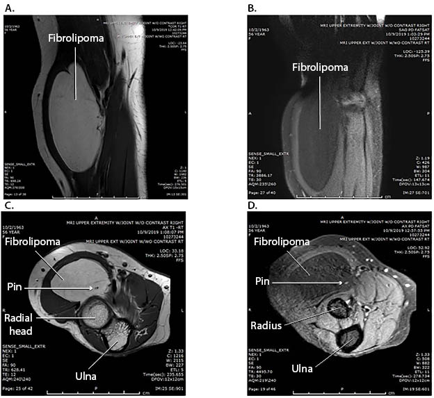 Neural Fibrolipoma Figure 2