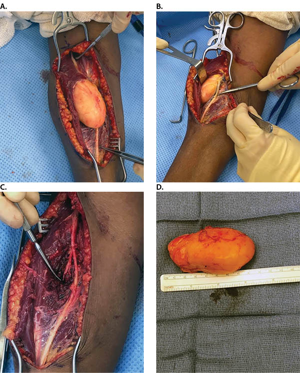 Neural Fibrolipoma Figure 3