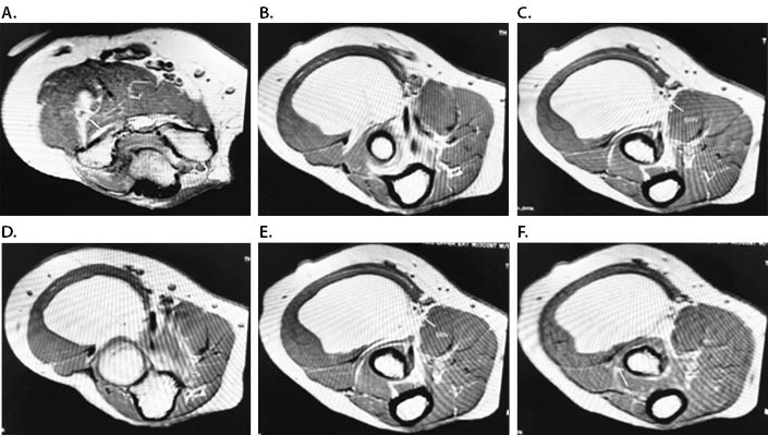 Neural Fibrolipoma Figure 4